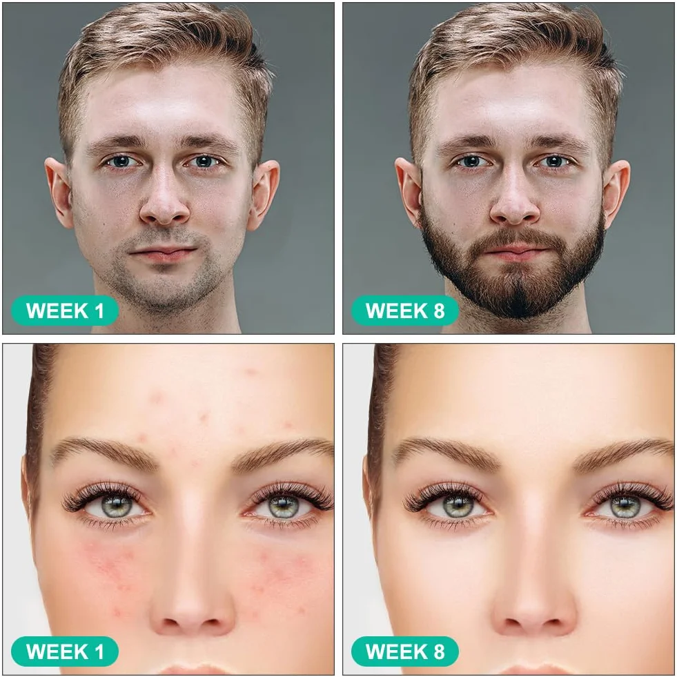 ACWOO Roller do brody 0,5 mm, Derma roller, Mikroigłowa rolka do brody, stymulująca wzrost, Derma roller do twarzy/ciała, Mikroigłowy pen do usuwania blizn, Mikroigłowa rolka do pielęgnacji skóry