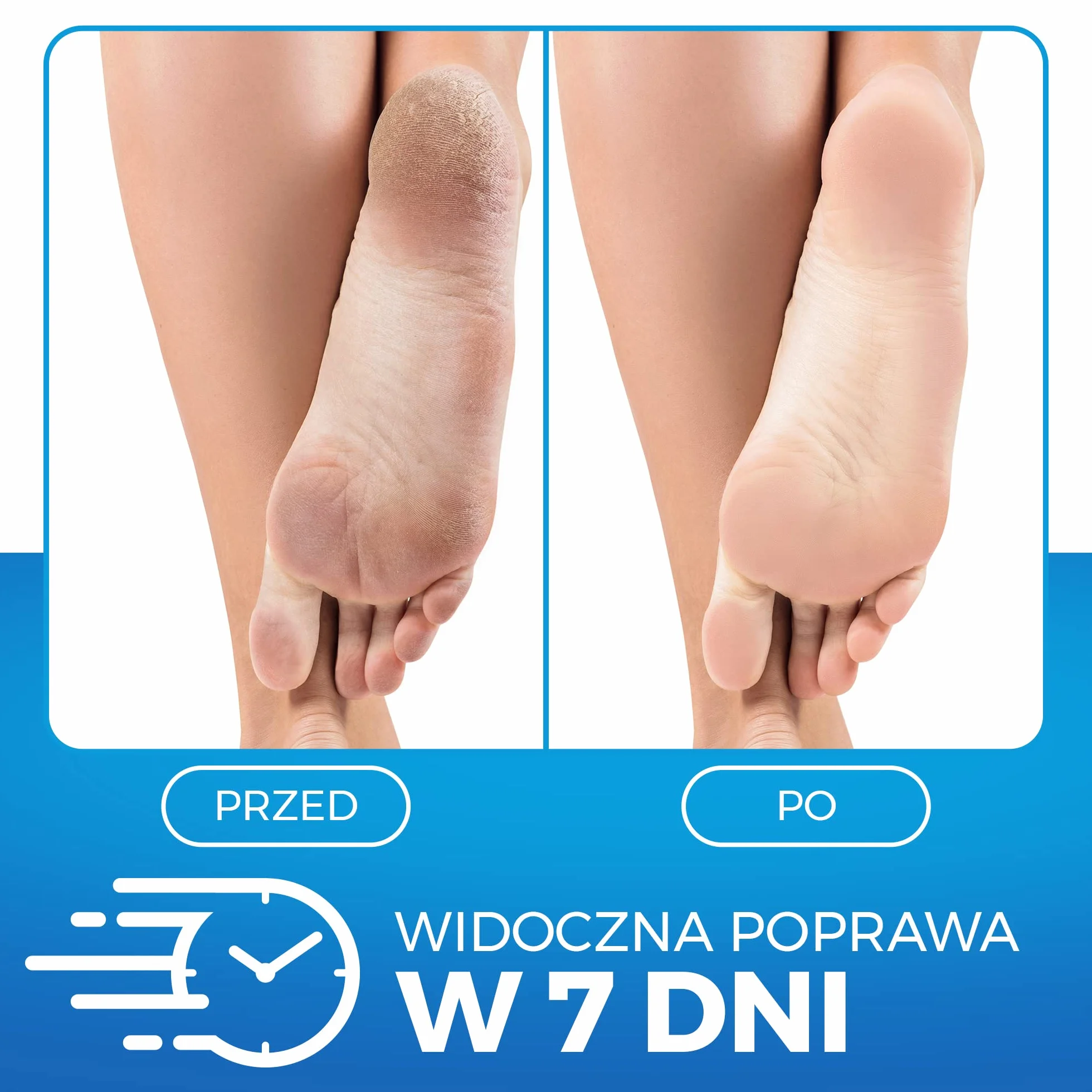 Imperial Feet Krem do Stóp z Mocznikiem - Balsam na Suche, Szorstkie i Popękane Pięty - Pielęgnacja Skóry Rąk i Nóg - Naturalny Mocznik Dobry Dla Stóp - Oczyszczająco- Złuszczający - 150ml