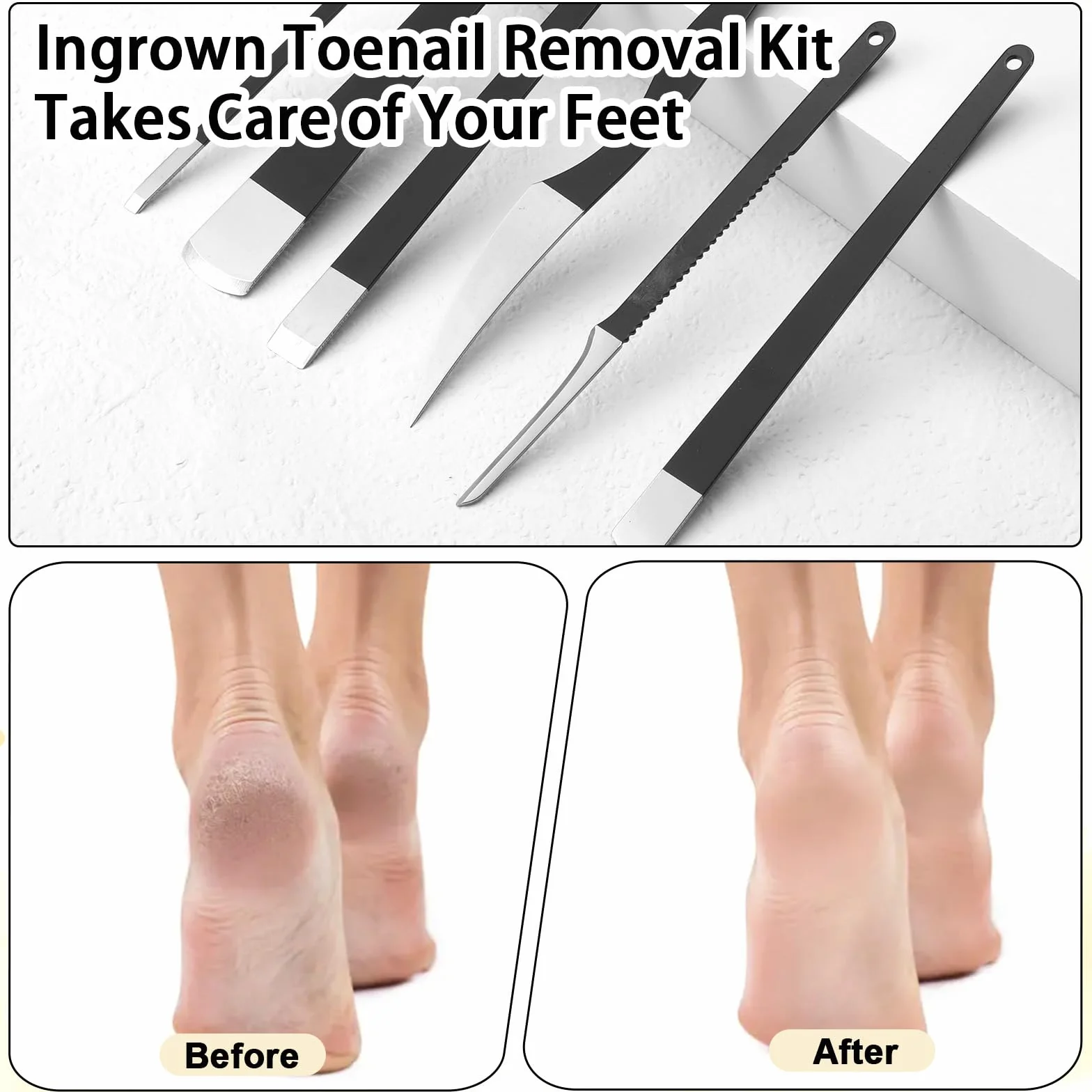 Zestaw do usuwania wrastających paznokci u stóp, profesjonalne zestawy noży do pedicure, golarka do stóp ze stali nierdzewnej, z pudełkiem do przechowywania, narzędzia do pielęgnacji stóp, do
