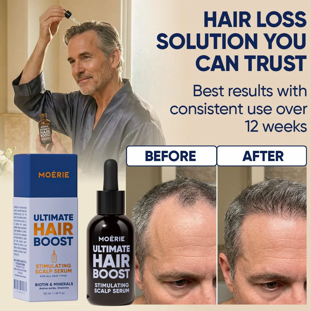 MOERIE Hair Growth Serum 50 ml – przyspiesza porost włosów i zapobiega wypadaniu włosów u kobiet – serum na porost włosów na skórze głowy – serum przeciw wypadaniu włosów (zestaw 2 szt.)