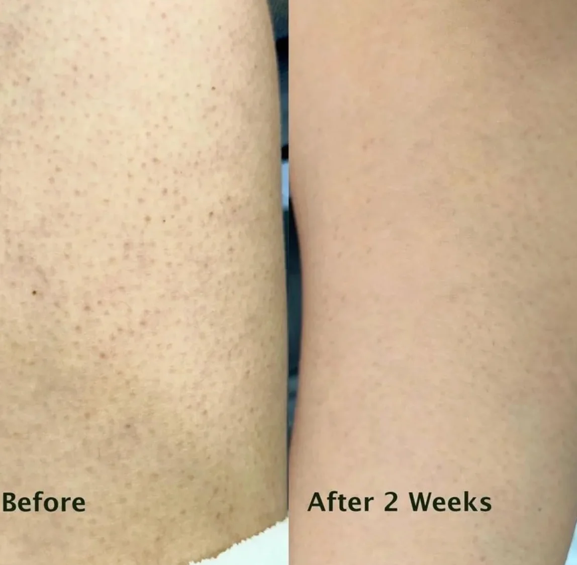 Peeling chemiczny AHA/BHA do ciała na rogowacenie mieszkowe, truskawkowe nogi i wrastające włoski z kwasem salicylowym, glikolowym i pestkami moreli