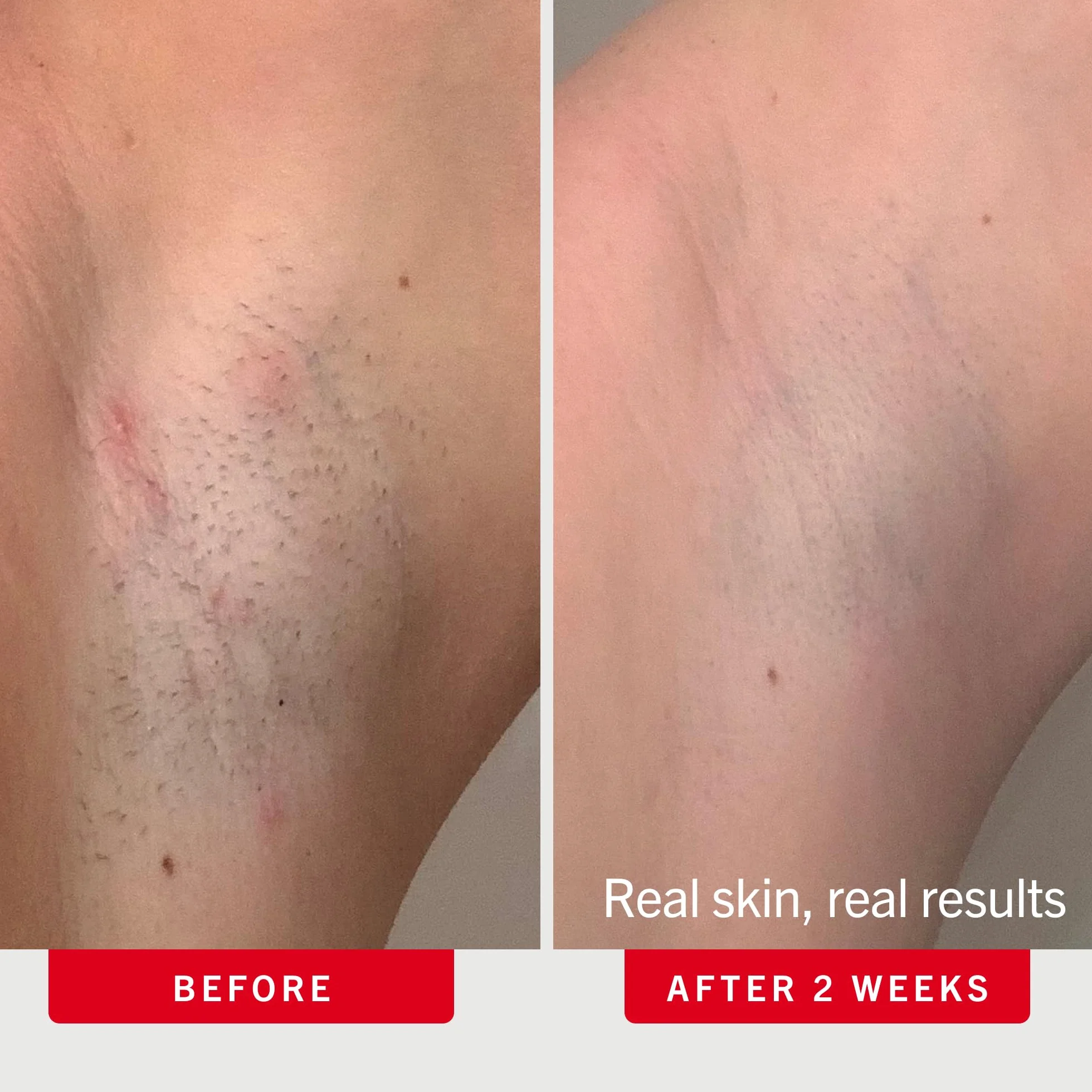 First Aid Beauty Płatki na wrastające włoski BHA AHA po goleniu złuszczające skórę pod pachami