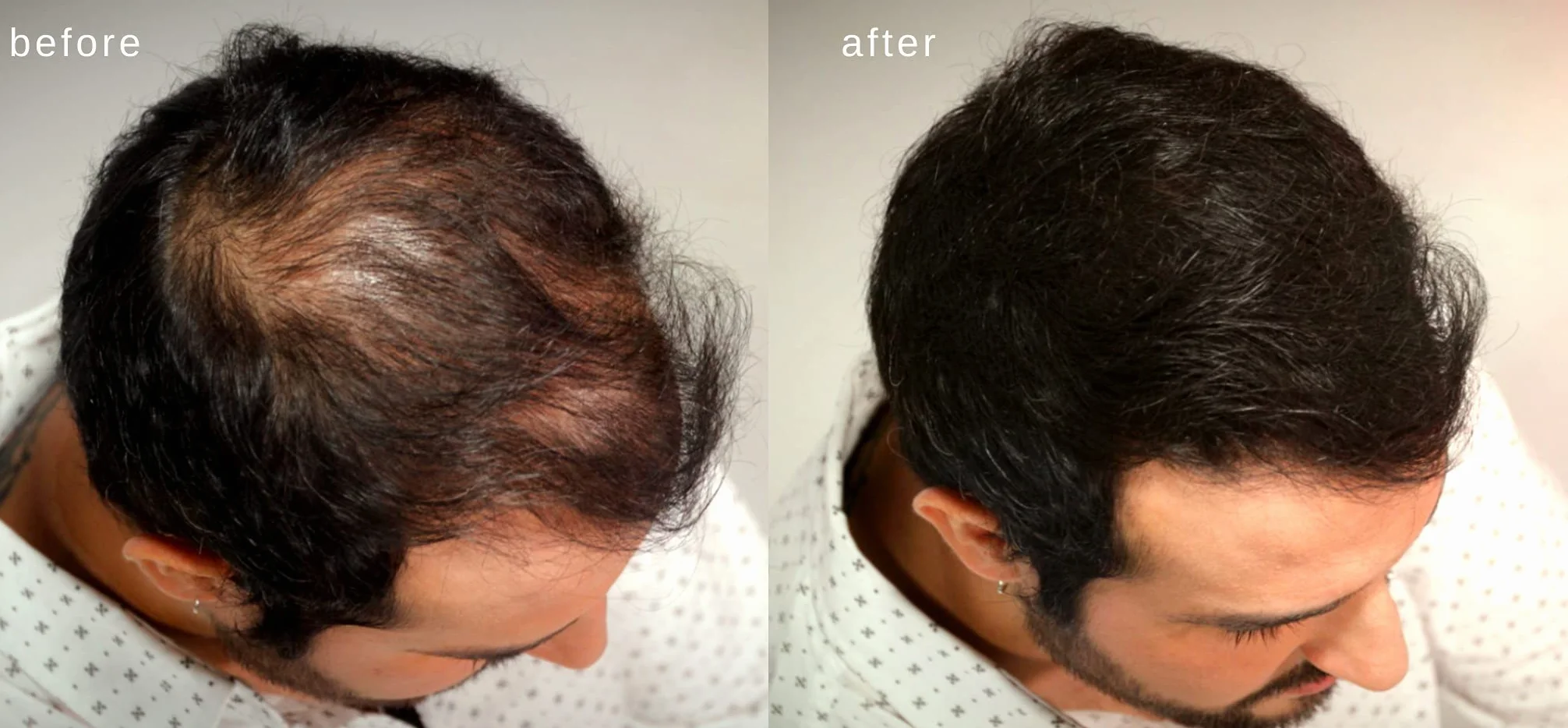 Zwiększające Objętość Włókna Włosów Z Prawdziwą Keratyną Do Przerzedzania Włosów / Wypadania Włosów - Testowane Dermatologicznie I Certyfikowane Jako Hipoalergiczne - 60 Dni + Dostawa - Dostępne W Wielu Kolorach (Ciemny Brąz)
