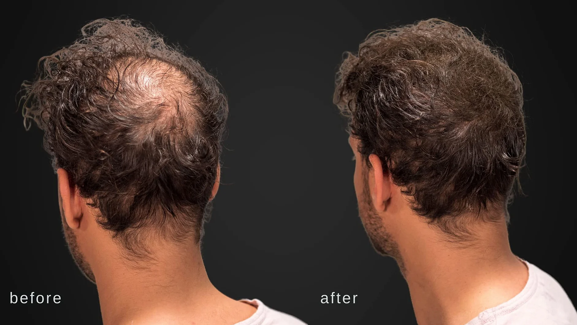 Zwiększające Objętość Włókna Włosów Z Prawdziwą Keratyną Do Przerzedzania Włosów / Wypadania Włosów - Testowane Dermatologicznie I Certyfikowane Jako Hipoalergiczne - 60 Dni + Dostawa - Dostępne W Wielu Kolorach (Ciemny Brąz)