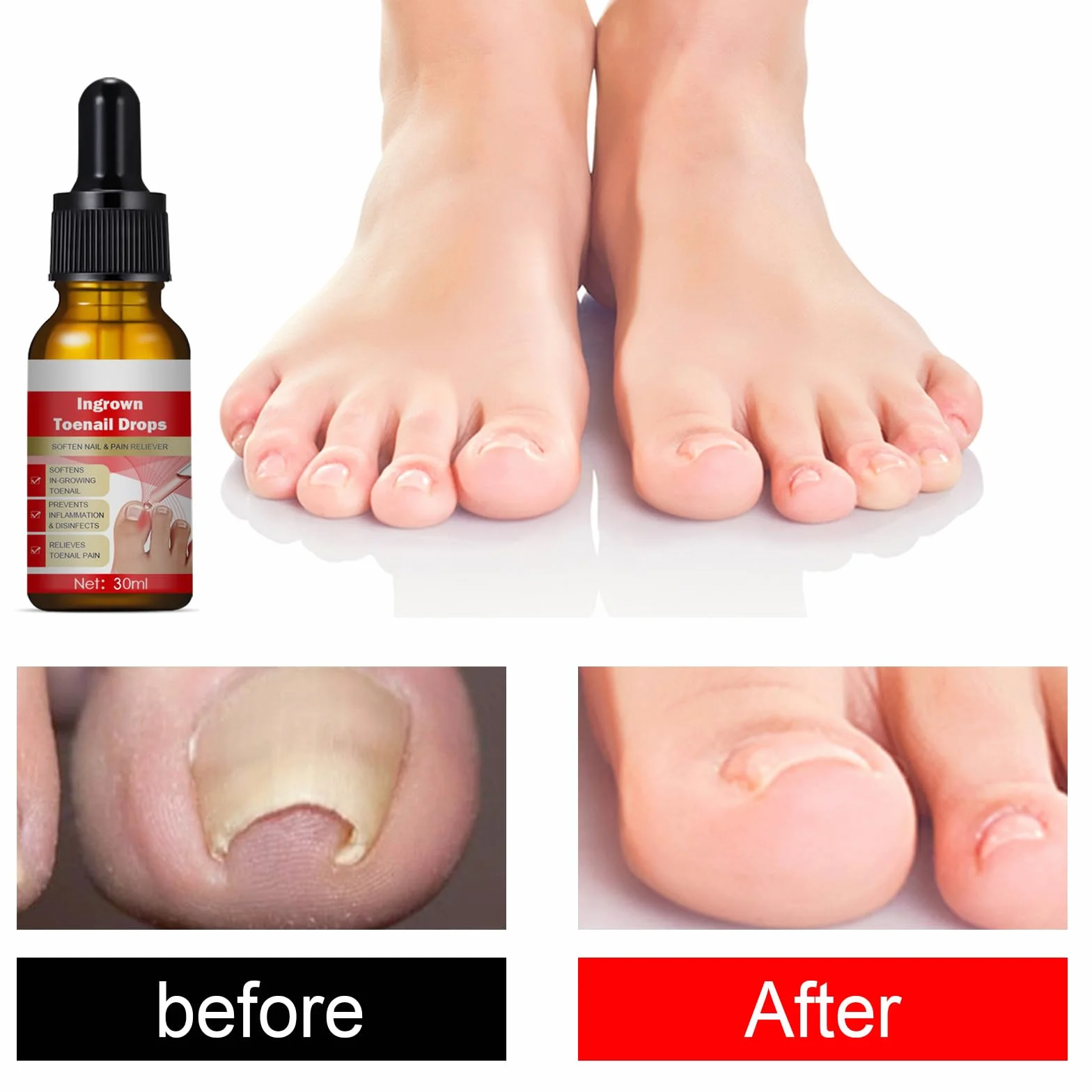Olejki do pielęgnacji wrastających paznokci - Leczenie 30 ml