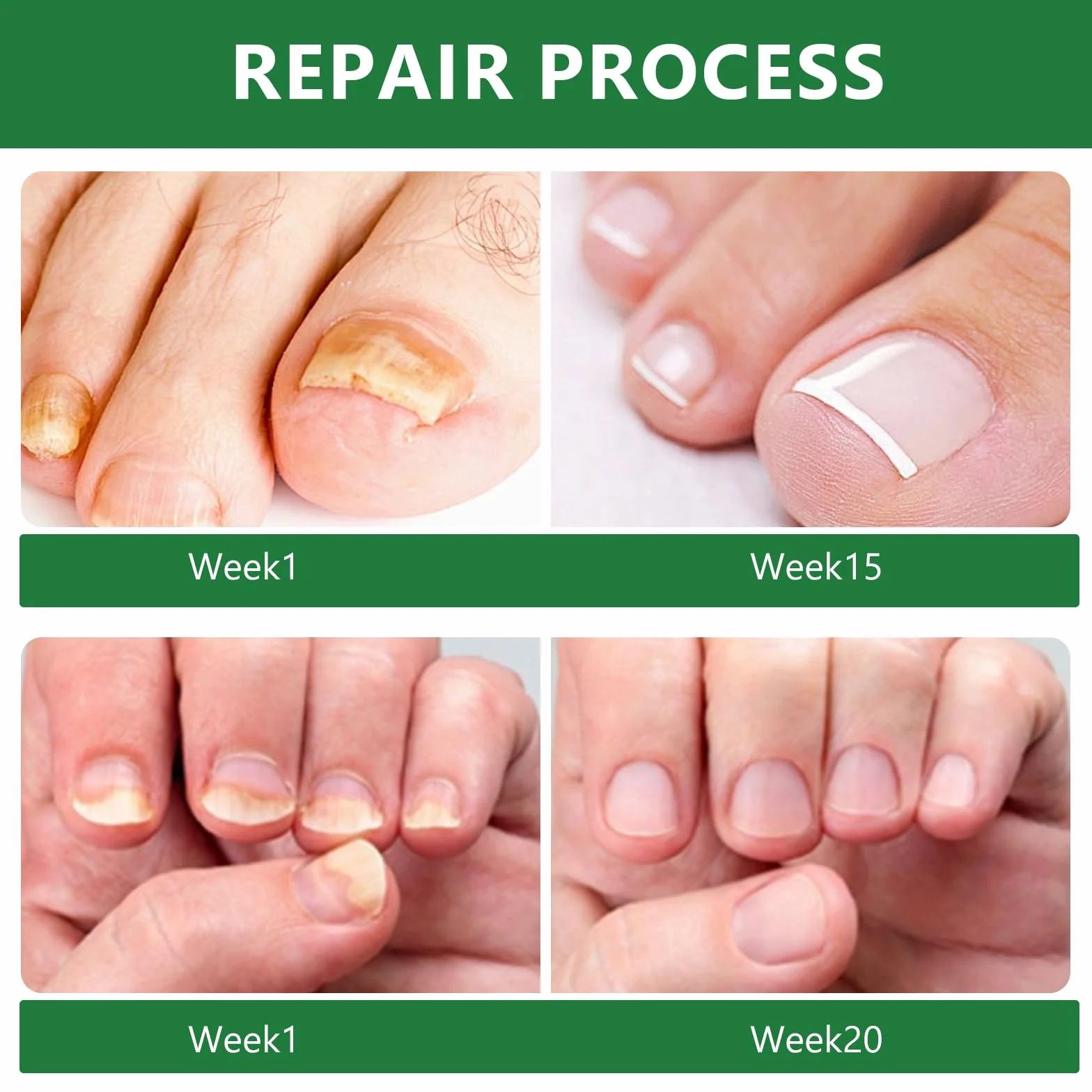 30ML Pielęgnacja Paznokci Stop,Nail Repair Solution,Pielęgnacja Uszkodzonych Paznokci,Nadaje się do Palec I Pedicure Professional Care,Naprawy i Zapobieganie Nail