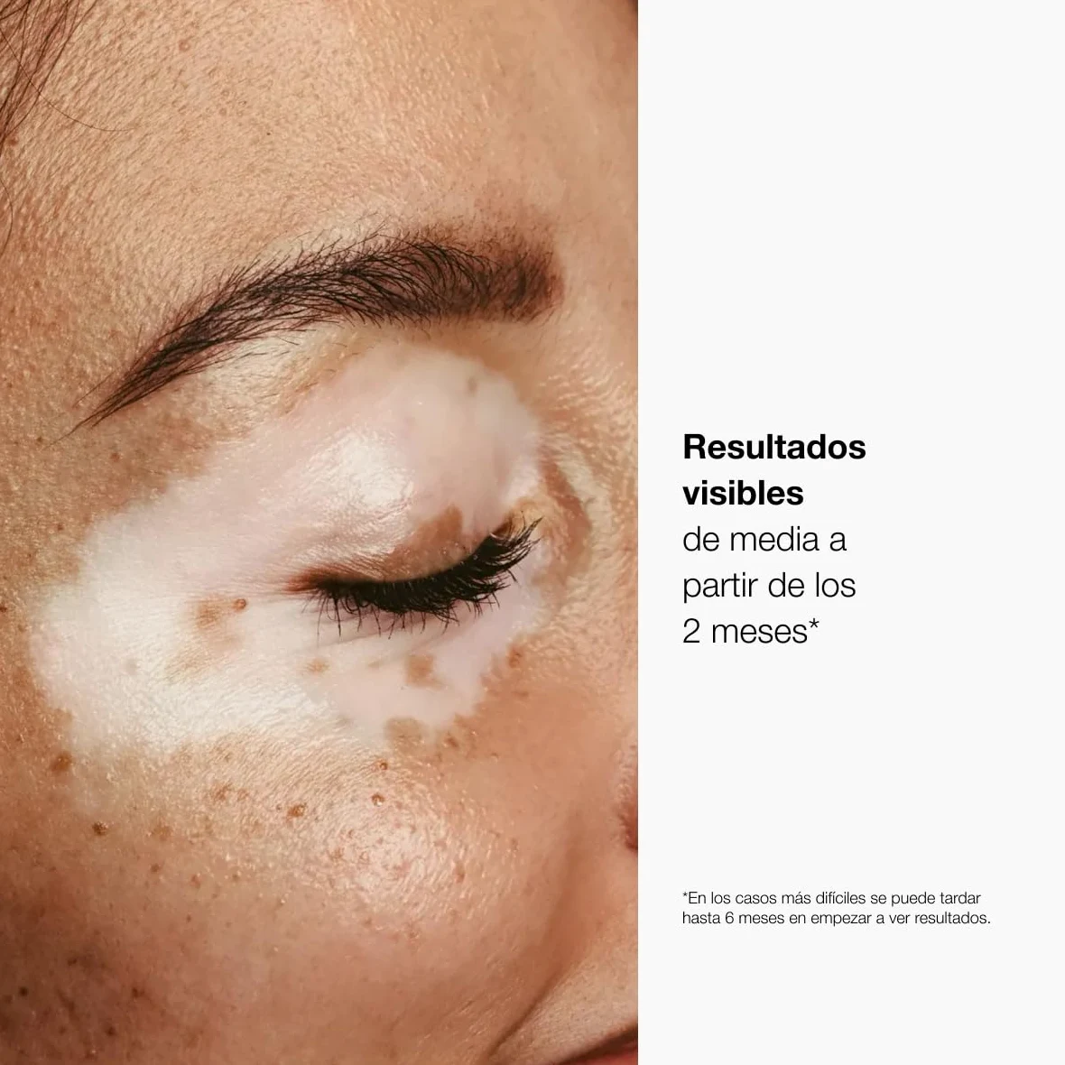 Repigment12 Plus Crema Repigmentante