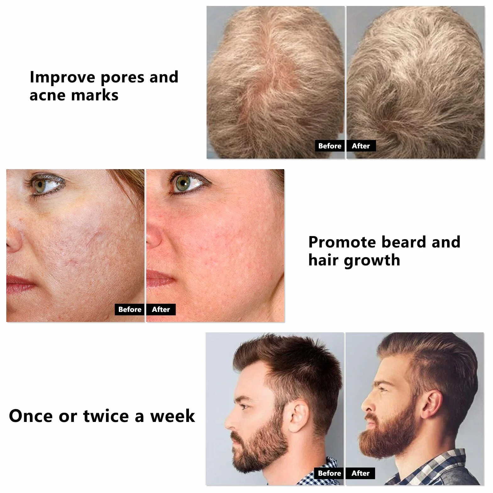 Derma Roller 1,0 mm Microneedling 540 Pisaków Tytanowych z Mikroigłami do Twarzy, Ciała, Brody, Porostu Włosów, Zmarszczek, Blizn i Rozstępów