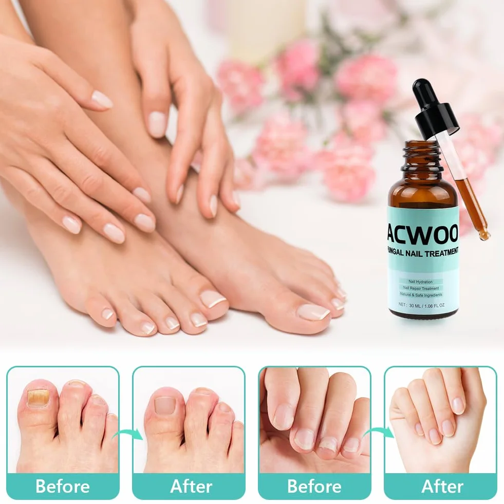 ACWOO Roztwór do leczenia grzybicy paznokci 30 ml, przeciwgrzybicze leczenie paznokci u stóp i paznokci bardzo mocne, naturalne składniki ziół skutecznie leczą, naprawiają i zapobiegają infekcjom