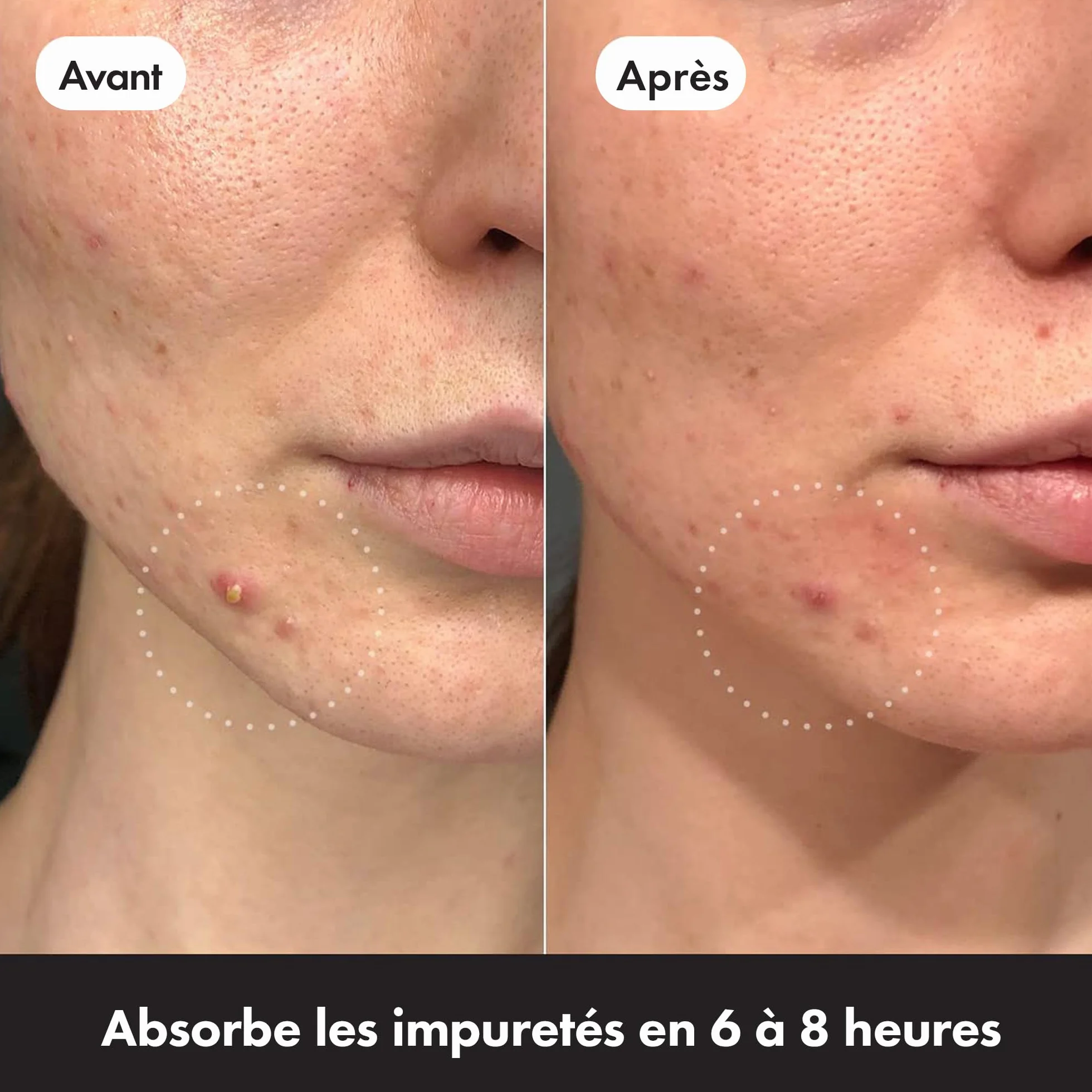 Hero Cosmetics Mighty Patch Invisible+ Spot Patches hydrokoloidowe przezroczyste plastry na trądzik
