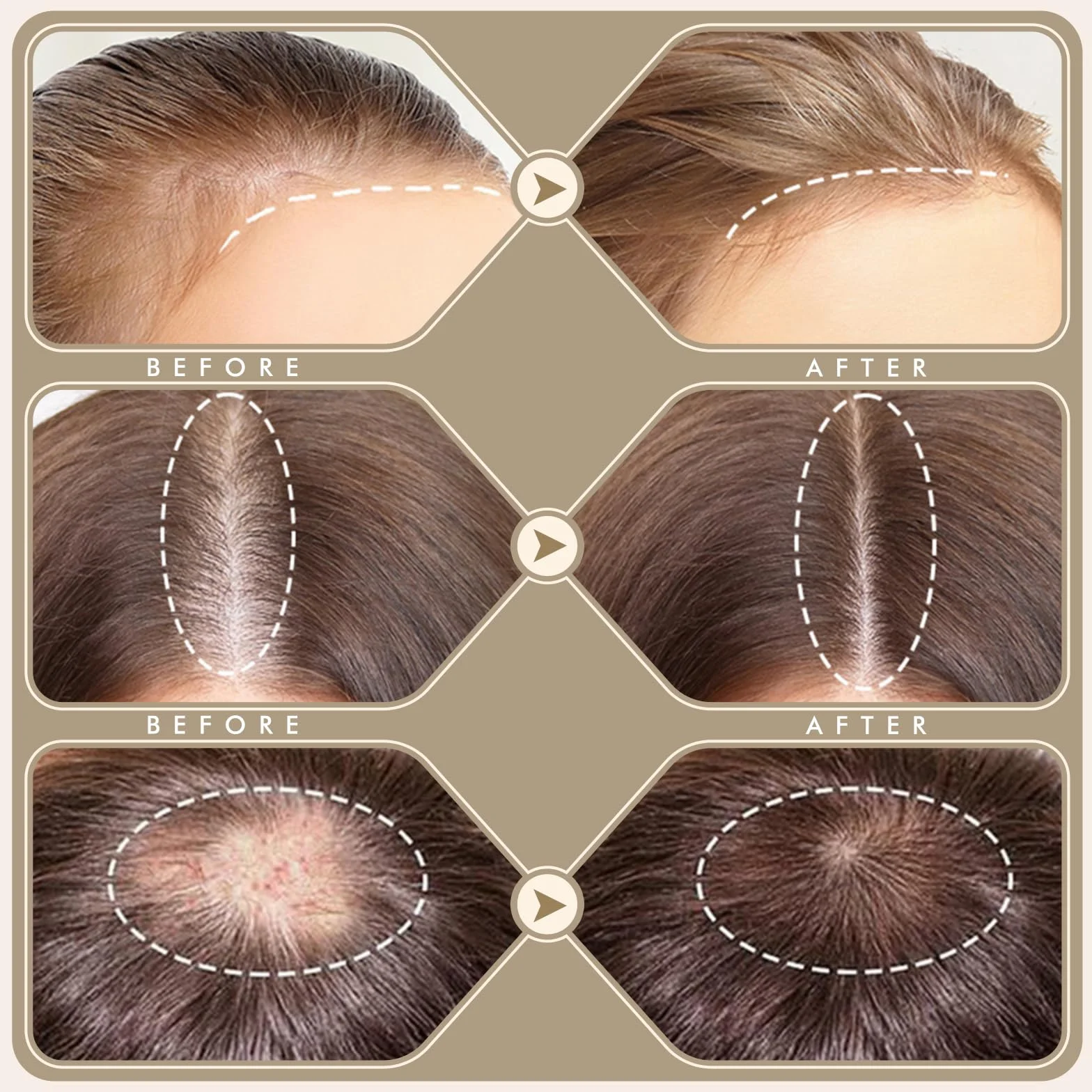 Derma Stamp 2 w 1 Upgrade 2025 – wymienne głowice, 64 piny + 120 pinów, regulacja 0-3,0 mm, mikroigłowanie, przeciw przerzedzaniu włosów, idealny prezent na Święto Dziękczynienia i Boże Narodzenie