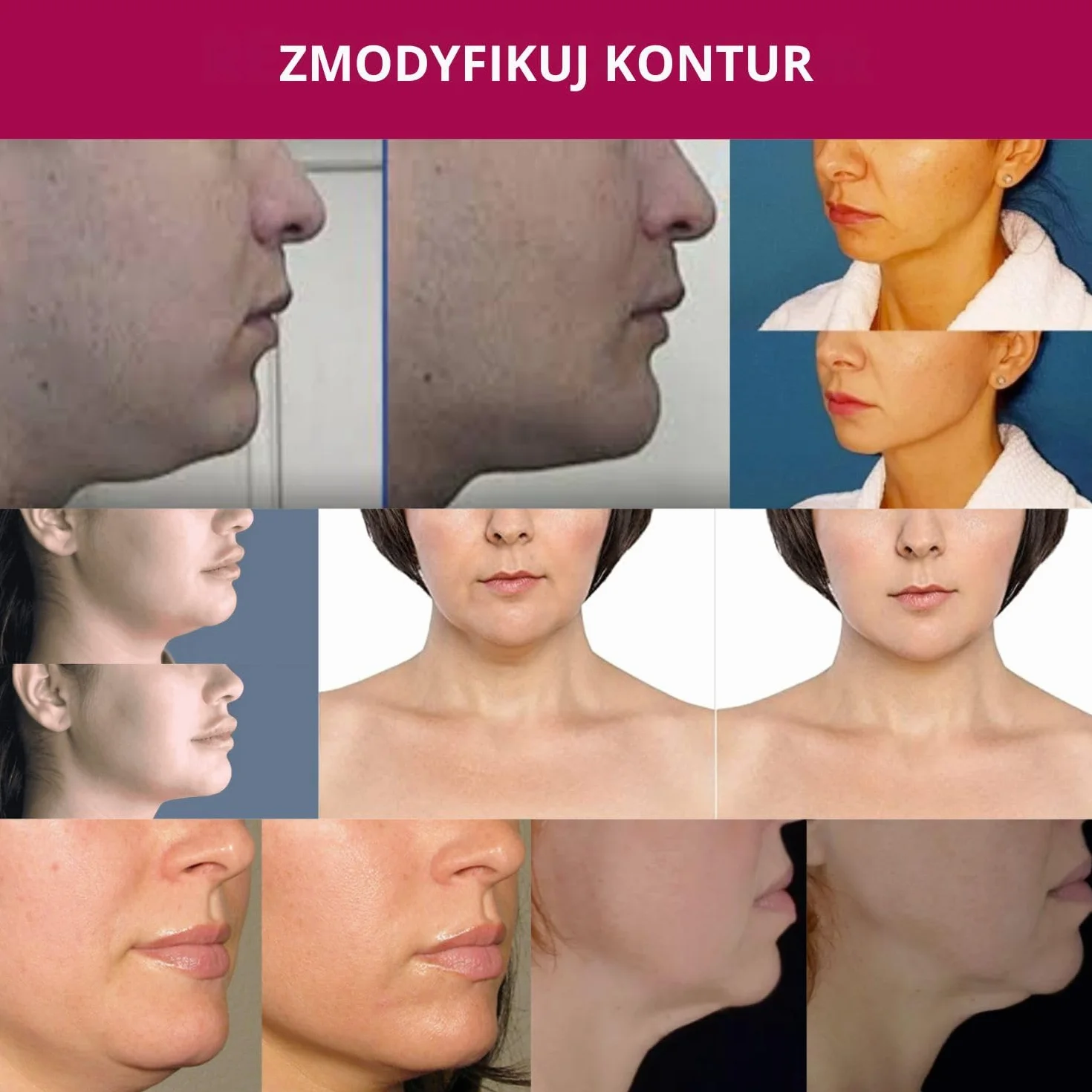 Zaawansowany krem ​​na szyję - Krem ​​przeciwstarzeniowy na szyję, podbródek i linię żuchwy dla kobiet i mężczyzn 30 ml