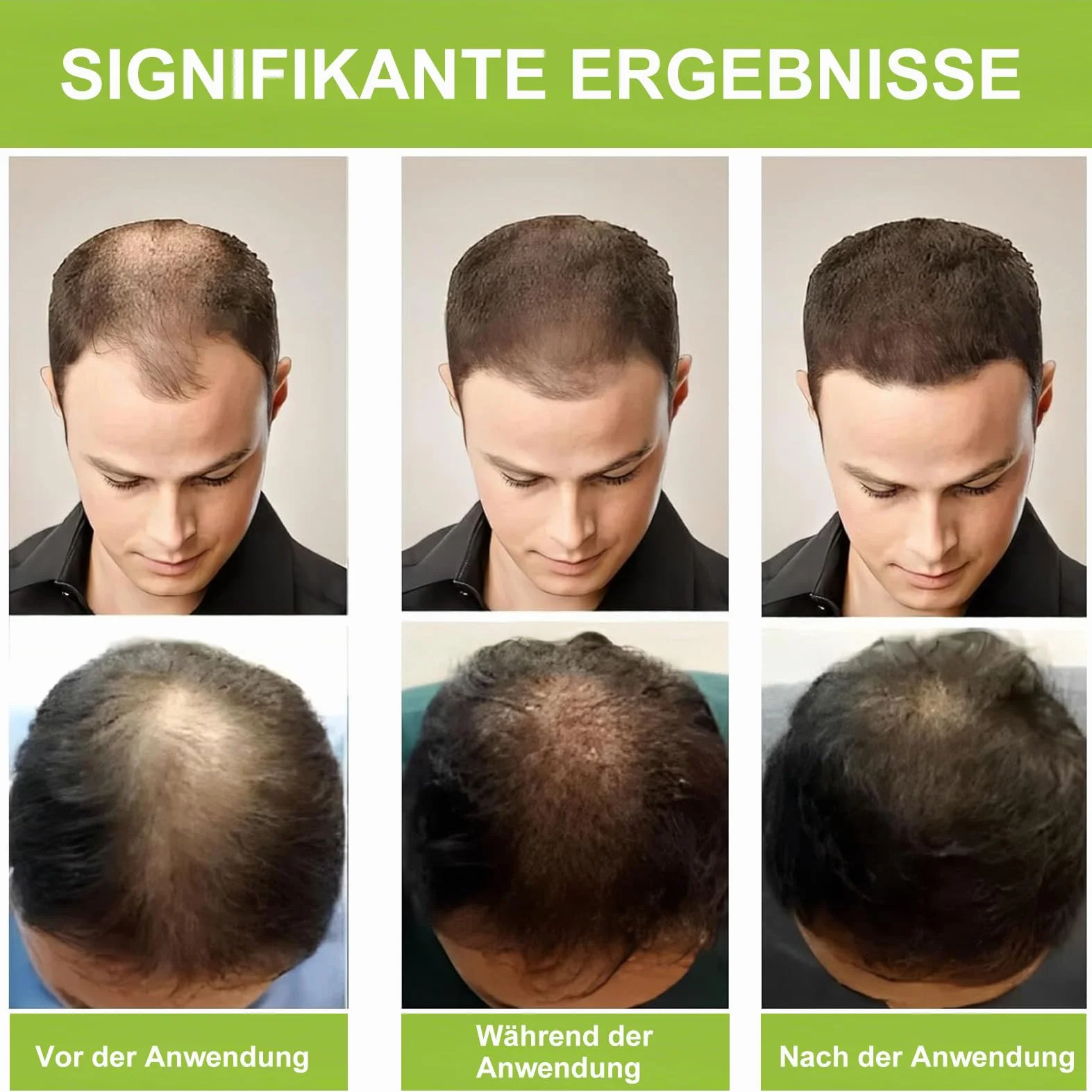 Microneedle Hair Regrowth System – system odrastania włosów, mikroinfuzja serum na wzrost włosów, wzmacnia cebulki włosów, wspomaga wzrost włosów, zapobiega wypadaniu włosów dla mężczyzn i kobiet