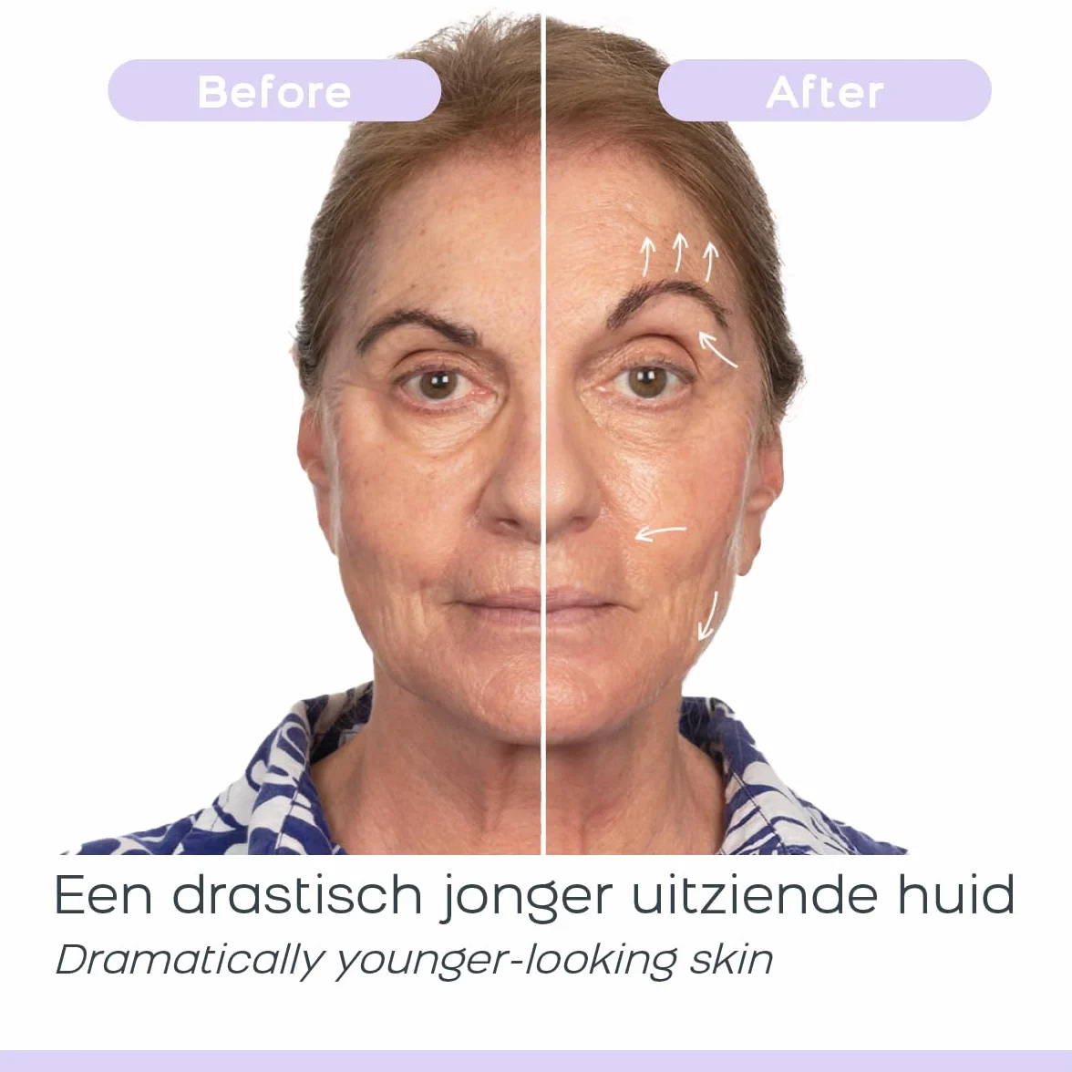 DermaWand Pro – profesjonalne urządzenie do pielęgnacji wysokiej częstotliwości | redukcja zmarszczek, ujędrnienie i połysk cery | + 50% wydajności