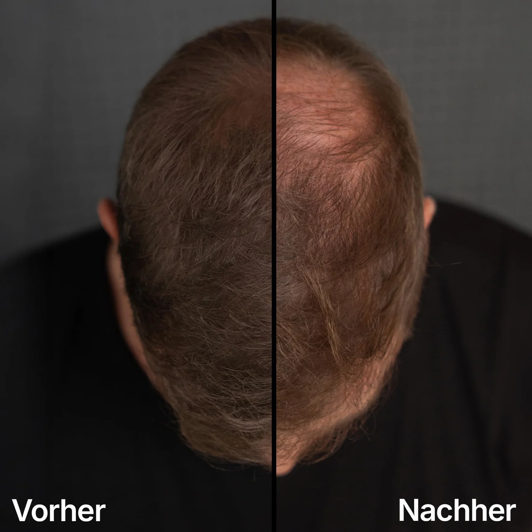LEON MIGUEL Puder do nasady – wodoodporny puder Hairline Powder jako idealny korektor do zakrywania nasady, niewidoczny makijaż włosów do zagęszczania włosów (ciemnobrązowy, Hairline Powder Pro)