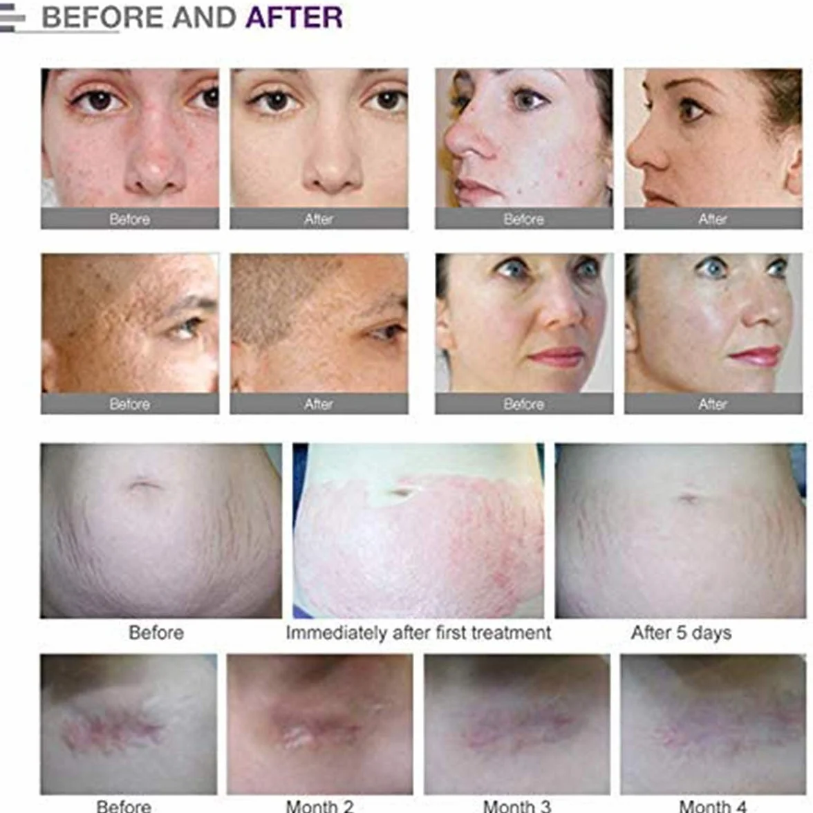 Dr.pen Ultima A6 Igły Zapasowe 10 szt. do Dermapen Microneedling
