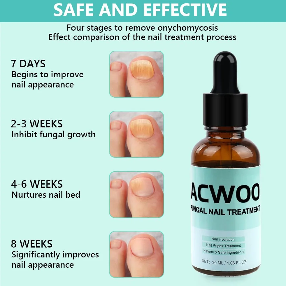ACWOO Roztwór do leczenia grzybicy paznokci 30 ml, przeciwgrzybicze leczenie paznokci u stóp i paznokci bardzo mocne, naturalne składniki ziół skutecznie leczą, naprawiają i zapobiegają infekcjom