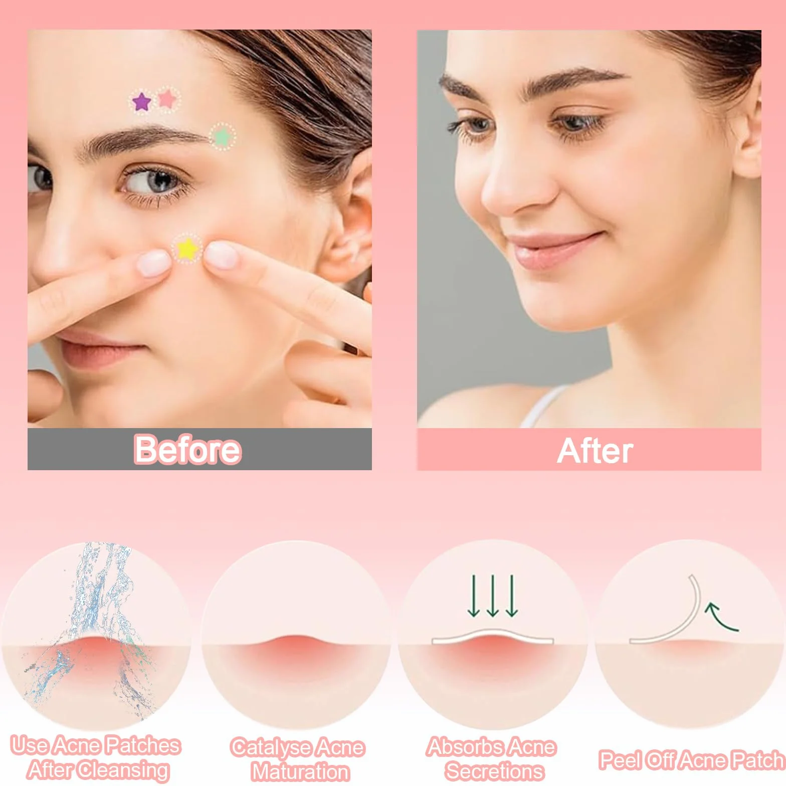 Absorptions Acne zestaw łatek na pryszcze, 232 sztuki, hydrokoloidowe łatki przeciw pryszczom, wodoodporne, oddychające plastry na trądzik w gwiazdki i okrągłe plastry na pryszcze, gwiazdki i
