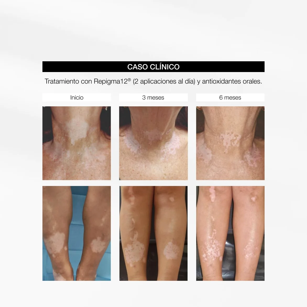 Repigment12 Plus Crema Repigmentante