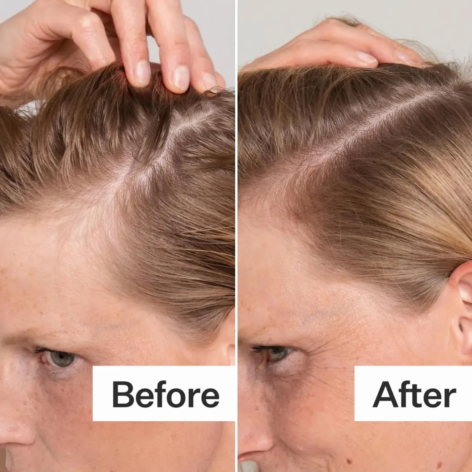 Microneedle Hair Regrowth System – system odrastania włosów, mikroinfuzja serum na wzrost włosów, wzmacnia cebulki włosów, wspomaga wzrost włosów, zapobiega wypadaniu włosów dla mężczyzn i kobiet