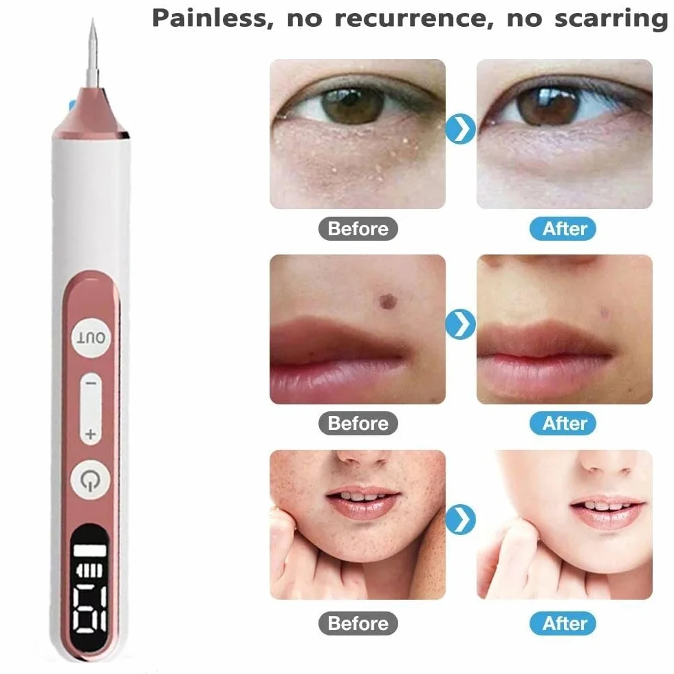 Plasma Pen Mole Remover 19 poziomów intensywności LED z wymienną igłą do twarzy i ciała