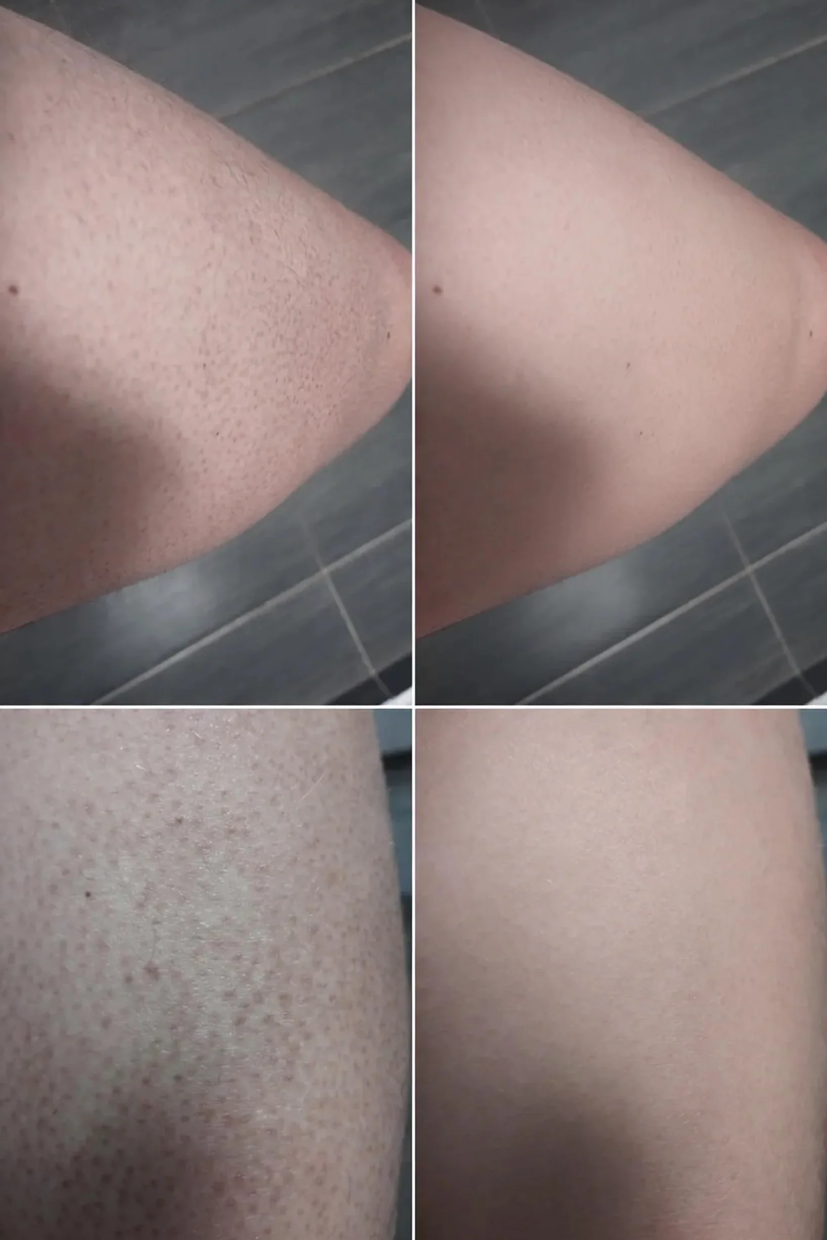 Peeling chemiczny AHA/BHA do ciała na rogowacenie mieszkowe, truskawkowe nogi i wrastające włoski z kwasem salicylowym, glikolowym i pestkami moreli