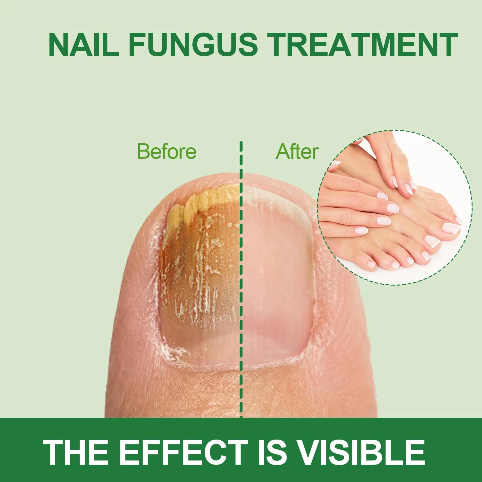30ML Pielęgnacja Paznokci Stop,Nail Repair Solution,Pielęgnacja Uszkodzonych Paznokci,Nadaje się do Palec I Pedicure Professional Care,Naprawy i Zapobieganie Nail