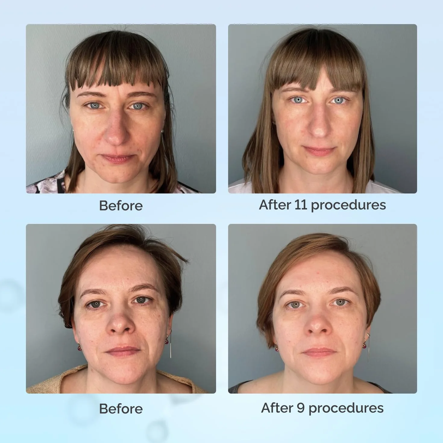 GESS FaceActive Professional BMS Biomechaniczny masażer do twarzy przeciwstarzeniowy ujędrniający redukujący zmarszczki