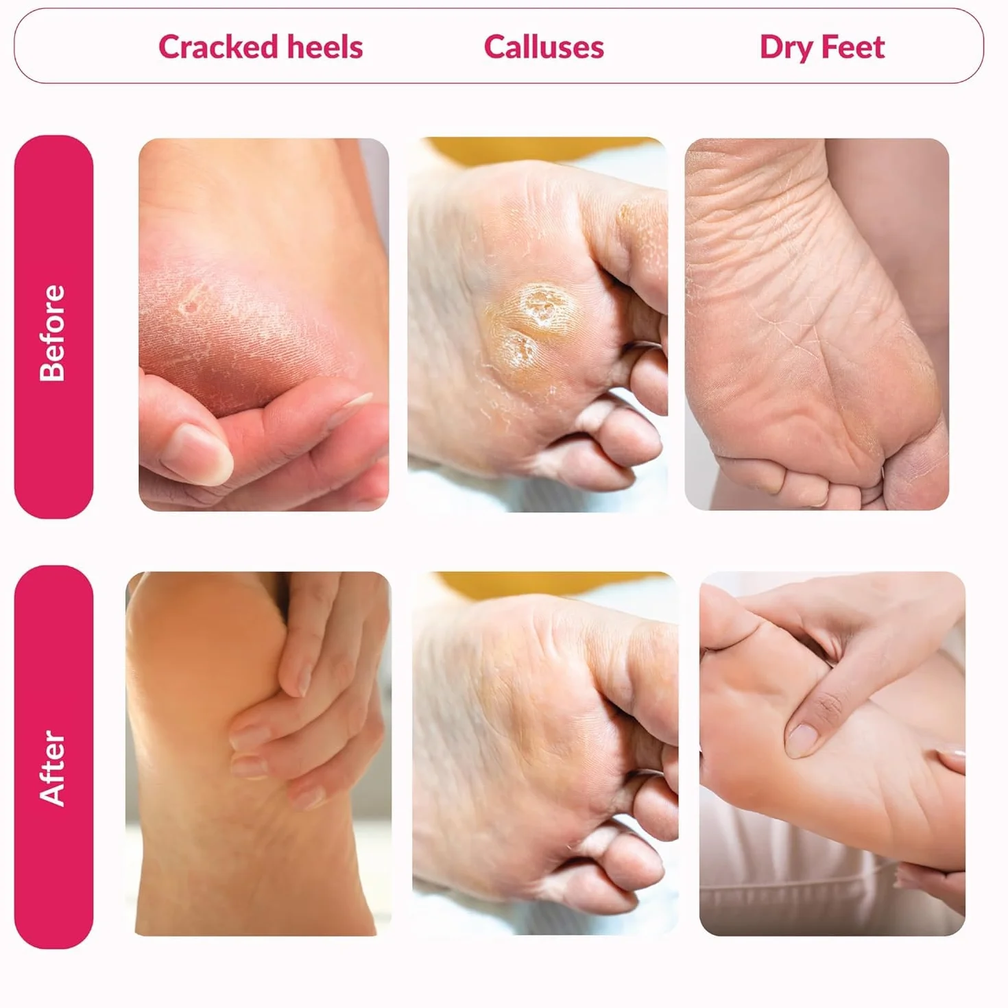 Summer Foot Premium maska do stóp do usuwania zrogowaciałego naskórka, aksamitnie miękkie i delikatne stopy po jednym zastosowaniu, przetestowana dermatologicznie, instrukcja obsługi w jęz. niemieckim