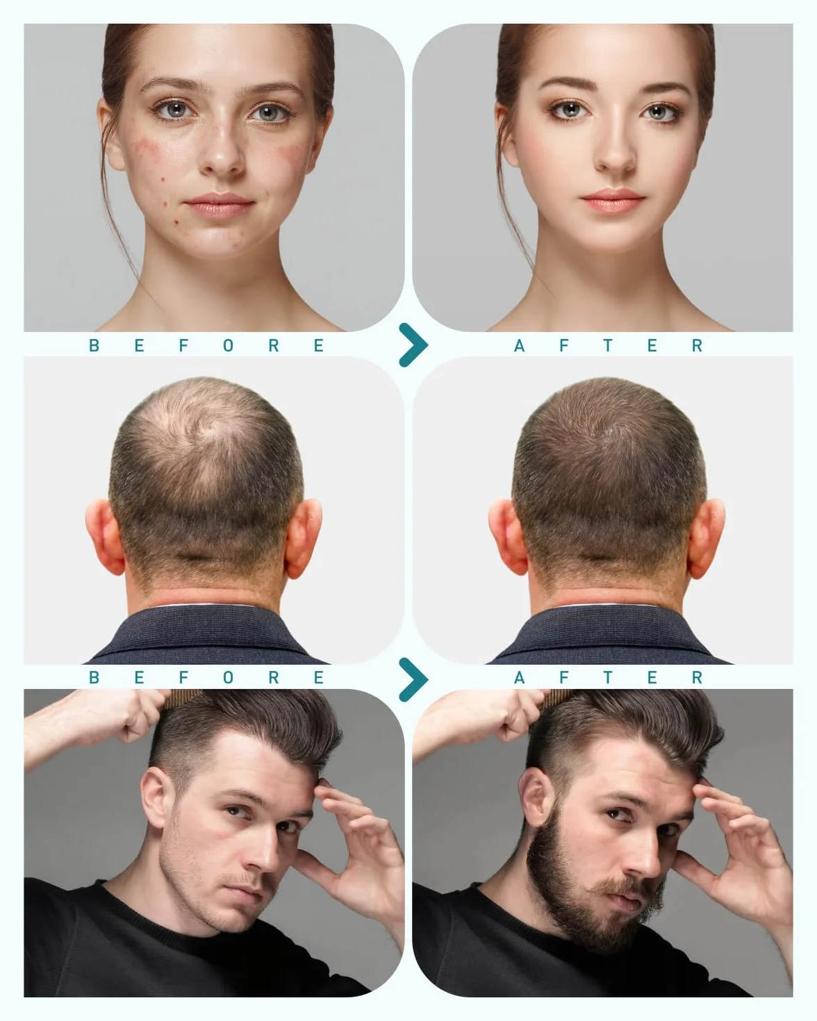 Derma Roller zestaw do mikroigłowania 720 pinów 0,5 mm przeciw zmarszczkom